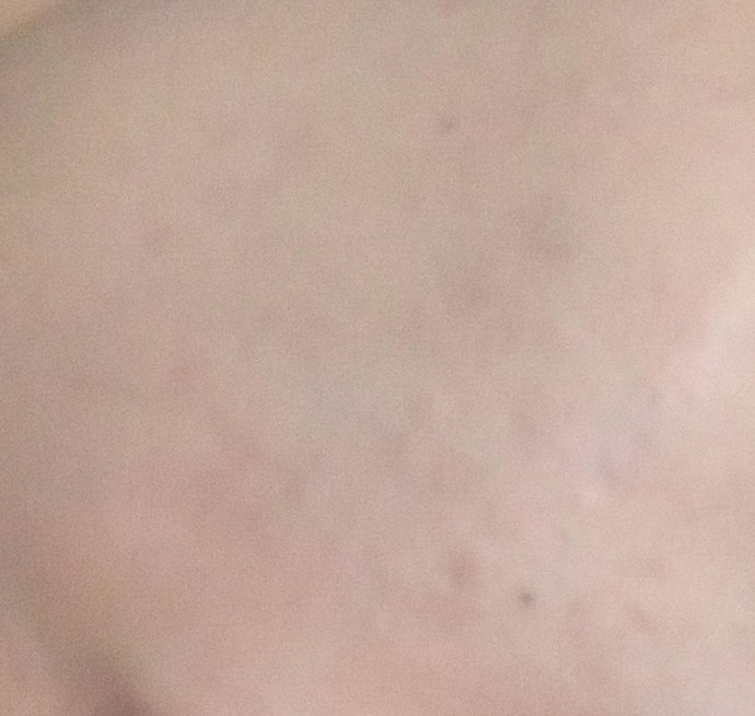 Yüzdeki lekeler lazer tedavisi ile geçer mi?