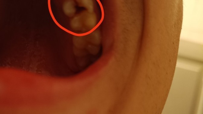 Arkadaşlar buz yerken ici boş olan dişim napcam?