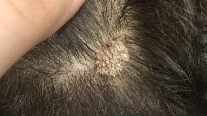 ÇOK ACİİİLLLL bakar mısınız? Erkek arkadaşımın saç derisinde böyle siğil gibi yaralar var sizce sebebi nedir?