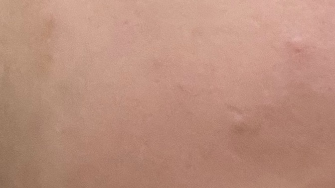 Yanağım sivilce doldu sadece sol taraf sizce neden olabilir ne iyi gelir?