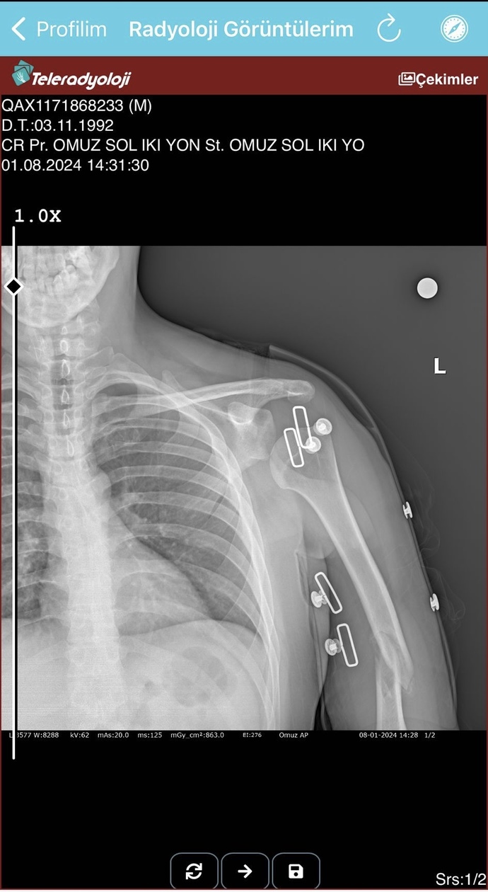 1 buçuk ay önce eşimin kolu kırıldı hala bu şekilde ve doktorlar takip edeceğiz deyip gönderiyor? Doktor tanıdığı olan fikir amaçl?