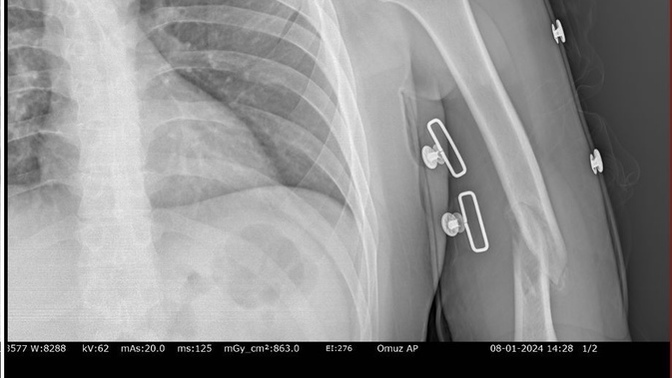 1 buçuk ay önce eşimin kolu kırıldı hala bu şekilde ve doktorlar takip edeceğiz deyip gönderiyor? Doktor tanıdığı olan fikir amaçl?
