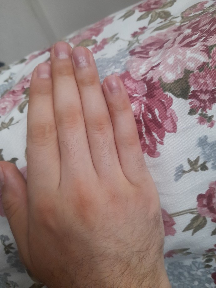 Yargılamazsanız sevinirim parmak boğumlarımda hep böyle kıllar var. bu kıllar normal midir?