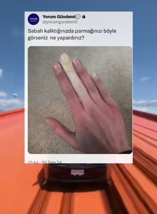 Sabah uyandınız ve parmağınız böyle 🤨ne yapardınız?