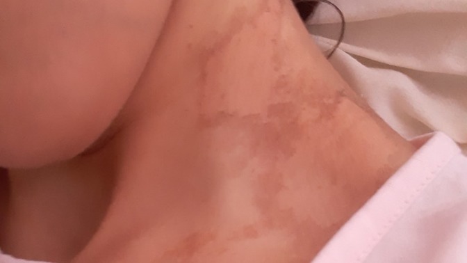 Boynumda kızarıklık oldu, beyaz leke falan kalır mı sonra?