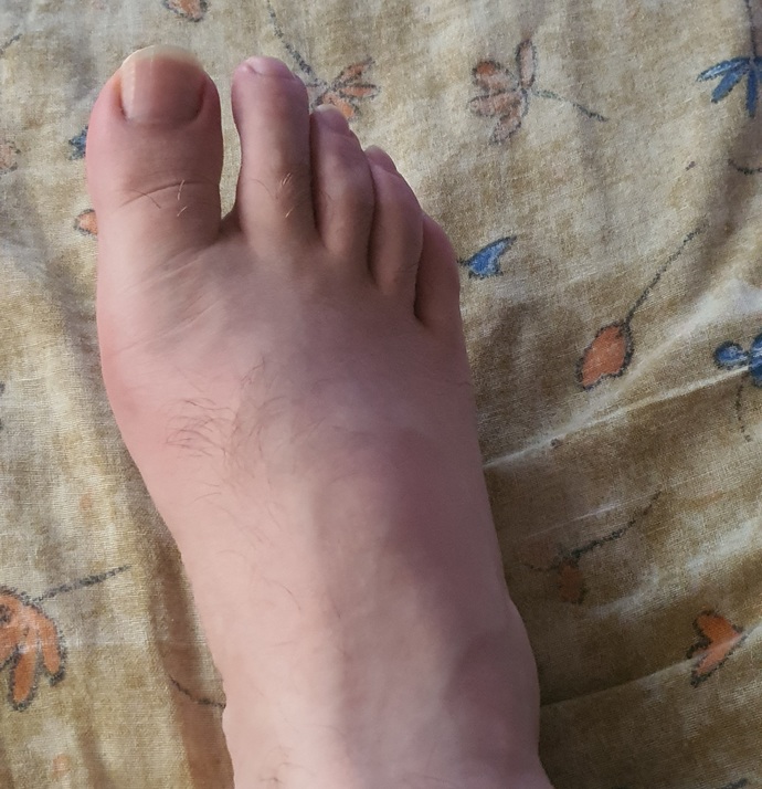 Ayak sismesi durup dururken?