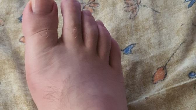 Ayak sismesi durup dururken?