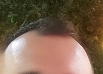 Saç ektirdikten sonra ağrı oluyor mu?