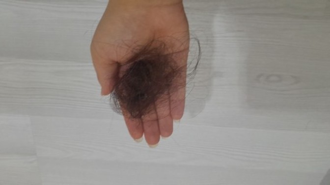 Aylardır sacim bu şekilde her tarafigimda dökülüyor?