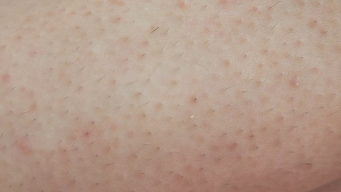 Ağdadan yeni geldim ama görüntü bu ya bence hic temiz olamayacak miyim bu nedir ya cozumu nedir bunun biri söylesin acill?