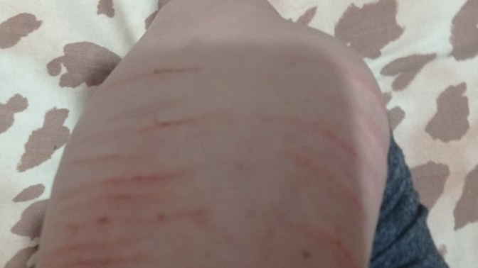 Bugun anlık bi sinirle bunları yaptım aşırı pişmanım geçer mi bunlar iz mi kalır?