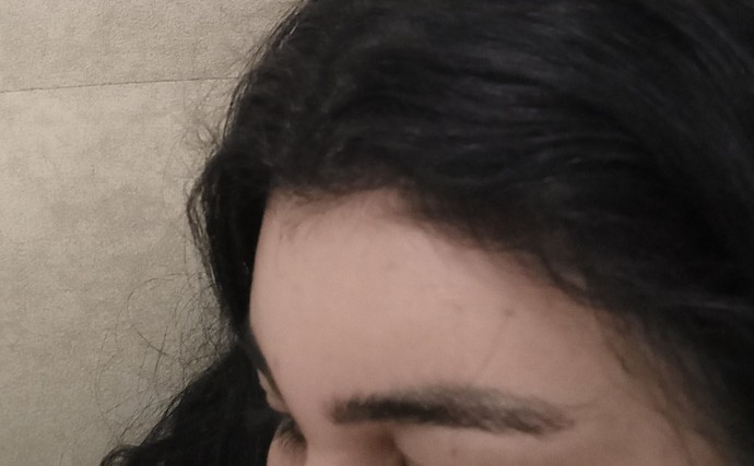 Saç boyasından alnım gözüm sisiyor napacam sacimi boyadim ondan?