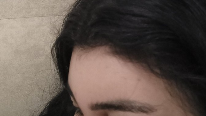 Saç boyasından alnım gözüm sisiyor napacam sacimi boyadim ondan?