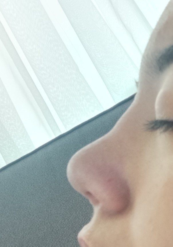 Burnumu yaptıralı tam bir yıl oldu ama böyle kemer gibi bişey var doktora sorduğum da 4 ay önce 2 seneye anca oturur burnun dedi?