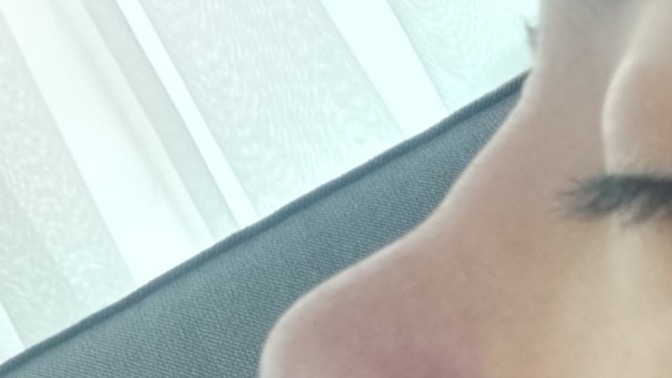 Burnumu yaptıralı tam bir yıl oldu ama böyle kemer gibi bişey var doktora sorduğum da 4 ay önce 2 seneye anca oturur burnun dedi?
