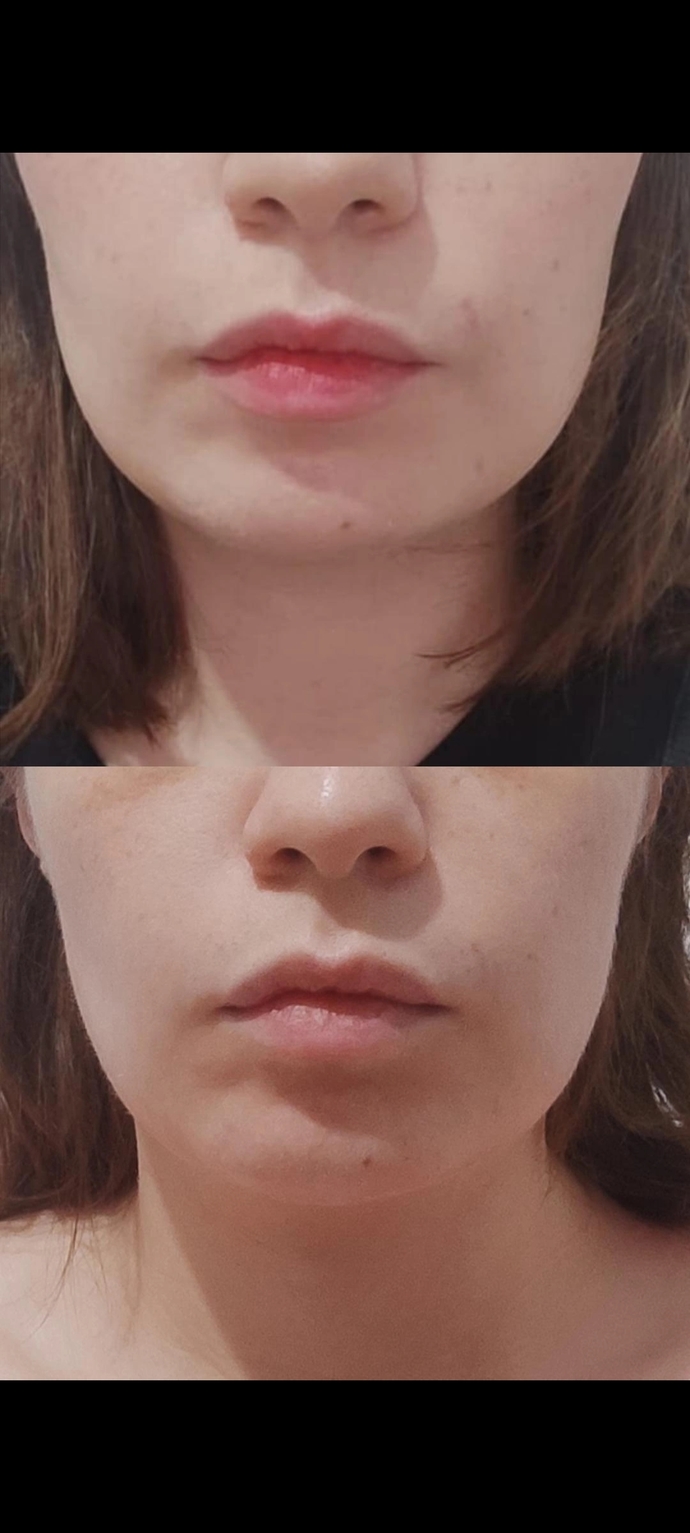 16 gün önce yaptırdığım masseter botoksu tutmamış mı sanki? (Çene köşelerini yumuşatan bir işlem) ?