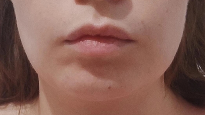 16 gün önce yaptırdığım masseter botoksu tutmamış mı sanki? (Çene köşelerini yumuşatan bir işlem) ?
