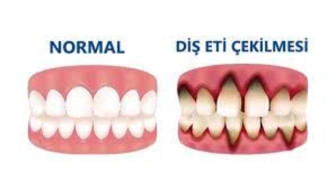 Diş eti çekilmesi ameliyatı?