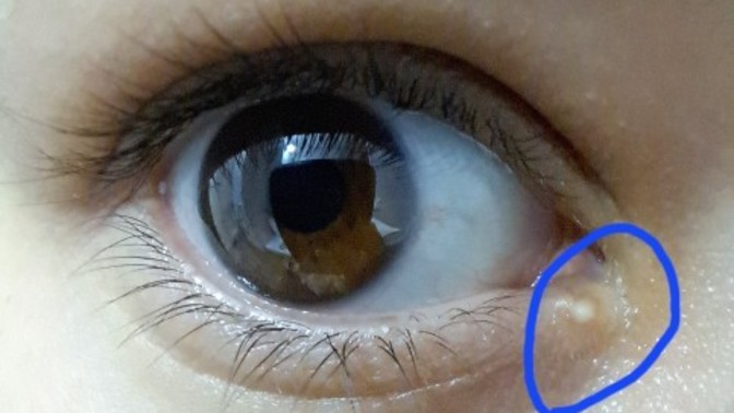 Yağ bezesi nasıl geçer?