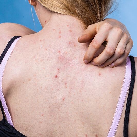 Vücudunda sivilceler yüzünden lekeler kalmış biriyle evlenir miydiniz?