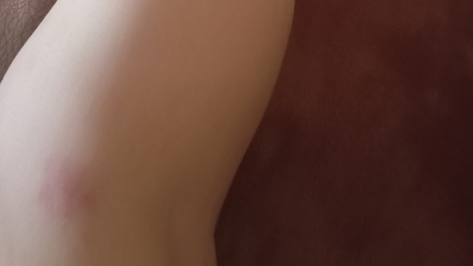 Benim gibi bacağı morarmış olan var mı?