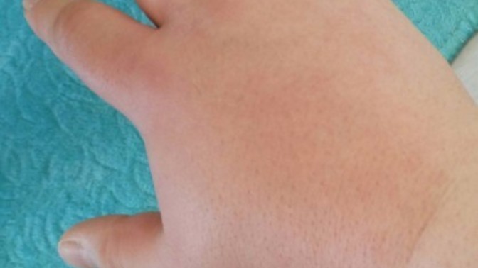 Ellerim hâlâ geçmedi , dermatolojiye gitsem düzelir mi?
