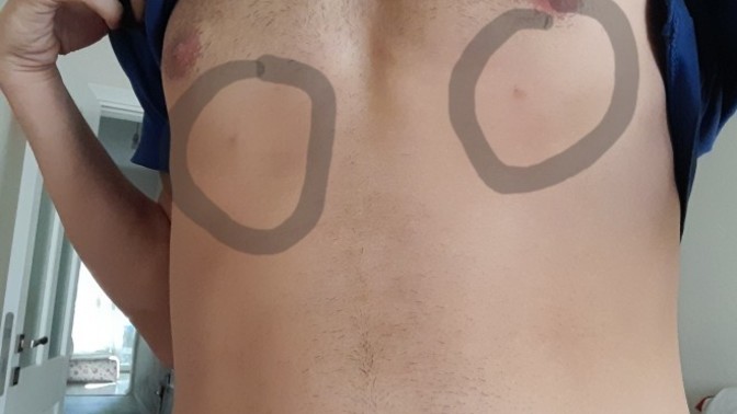 Göğüs Bölgesinde Çıkan 2 Tane Siyah Nokta Ne Olabilir?