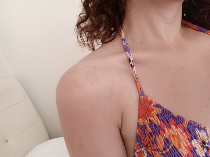 Güneş kremi sürmene rağmen kıpkırmızı oldum aciyoo napcam?