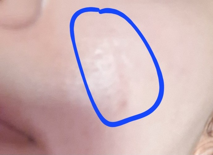 Yüzüm yanık oldu burası çizgi oldu geçer mi izi kalır mı dün oldu boşluk yok şu an fakat böyle görünüyor?