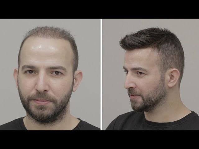 Protez saç hakkına ne düşünüyorsunuz?