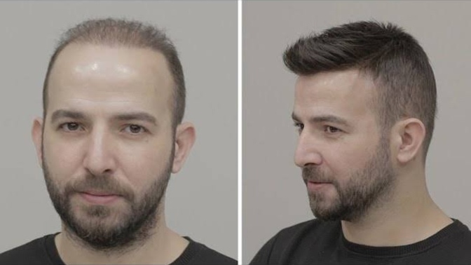 Protez saç hakkına ne düşünüyorsunuz?