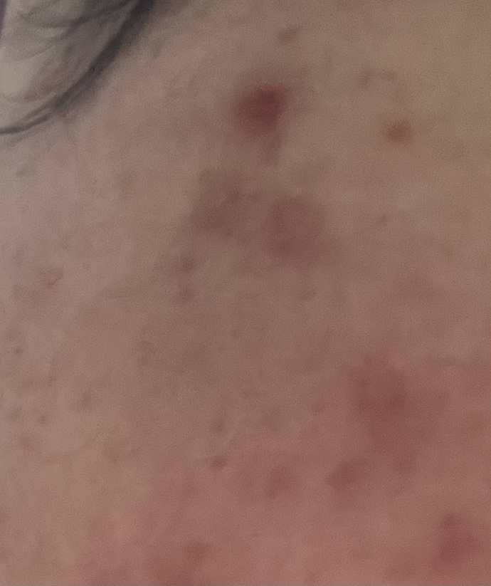 Yüzüm kırmızı sivilce lekeleri var nasıl geçer?