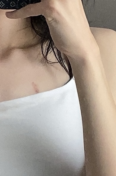 Siz göğüs tarafı böyle morarık birini görseniz ne düşünürsü?