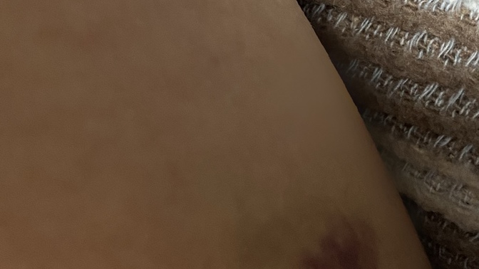 Üst bacak arkalarına doğru morluk nedir?
