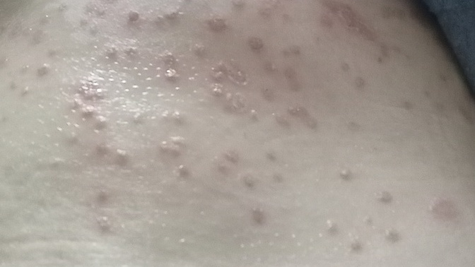Bütün vücudum bu halde, maymun çiçeği olabilir miyim :(?