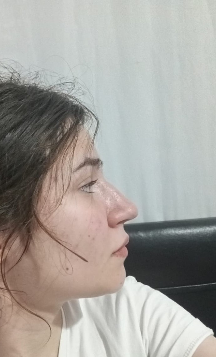 Sizce burnumun estetiğe ihtiyacı var mıııııı?