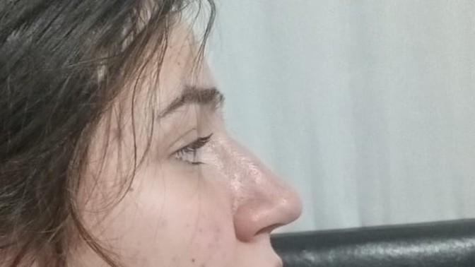 Sizce burnumun estetiğe ihtiyacı var mıııııı?
