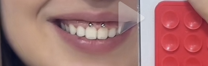 Smiley piercing kullanan var mı?