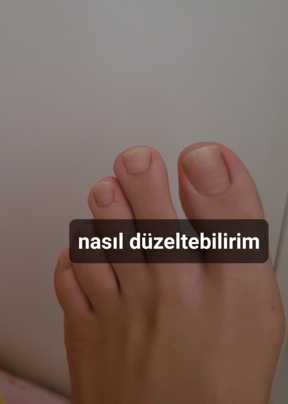 Ayak tırnak bakımı nasil olmali benim tirnak sorunum nedir ve nasil gecer?