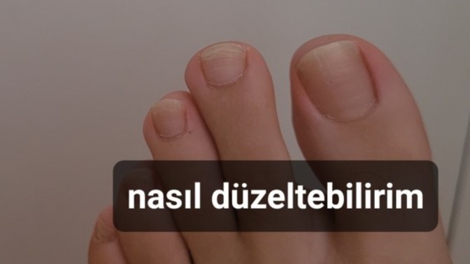 Ayak tırnak bakımı nasil olmali benim tirnak sorunum nedir ve nasil gecer?
