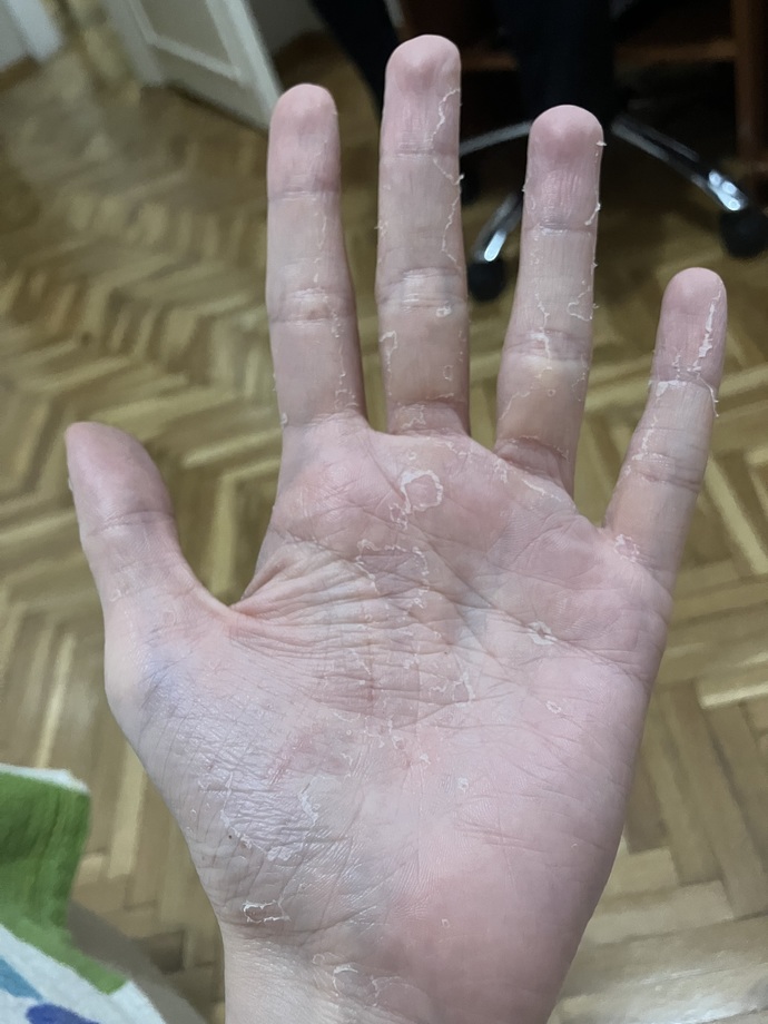 Arkadaşlar sizce bu elde Sedef mi egzama mi?