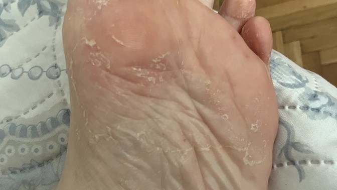Arkadaşlar bu durumu yaşayan oldu mu Sedef midir egzama mıdır nedir bu?