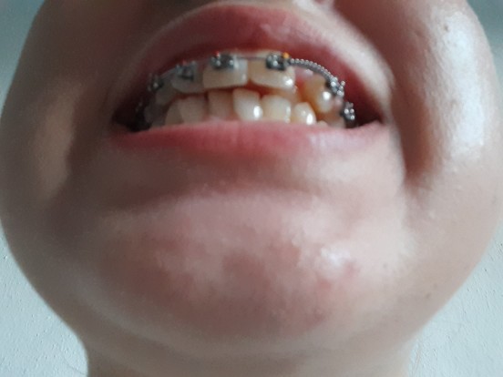 Alt cenem 1 2 cm geride ama?
