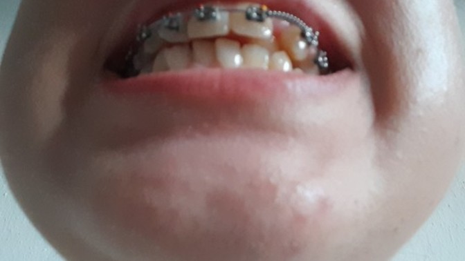 Alt cenem 1 2 cm geride ama?