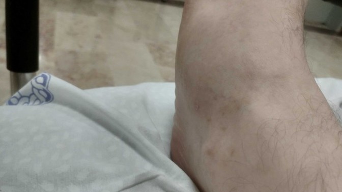 Ayak kırığı ne kadar sürede iyileşir?