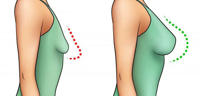 Göğüs Dikleştirme Ameliyatı Olmak İstiyorum Ama Çok Korkuyorum Yaptıran var mı?