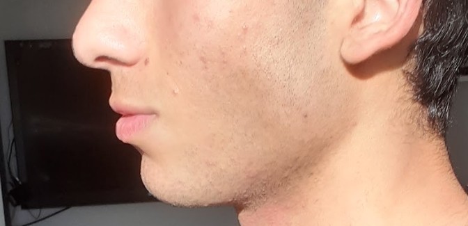 Sizce jawline mi yaptırmalıyım yoksa alt çene ameliyatı mı?