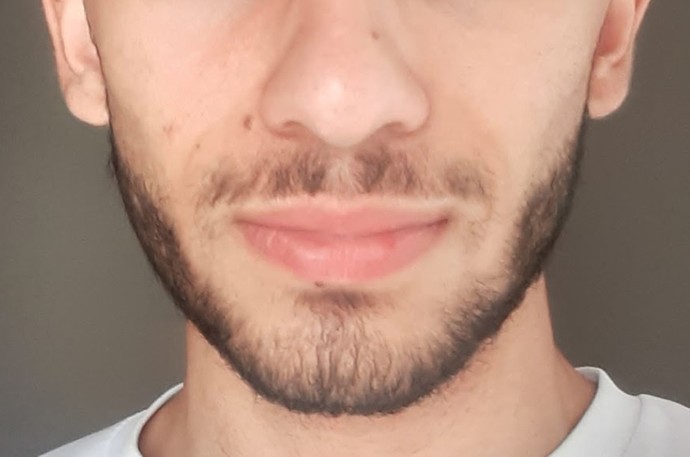 Sizce jawline mi yaptırmalıyım yoksa alt çene ameliyatı mı?