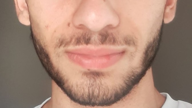 Sizce jawline mi yaptırmalıyım yoksa alt çene ameliyatı mı?