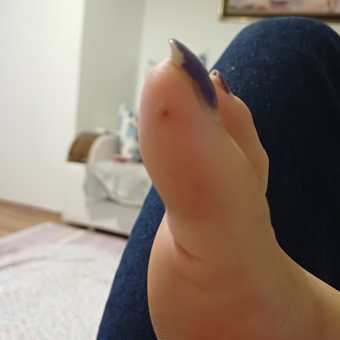 Ayagimda boyle bisi cikti gecmiyor koparmaya calisinca da kaniyor bu neden olur durduk yere cikti?